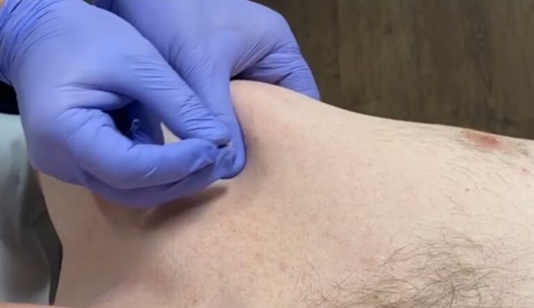 Dry Needling for Chest Conditions and Deformities: A Holistic Approach to Relief