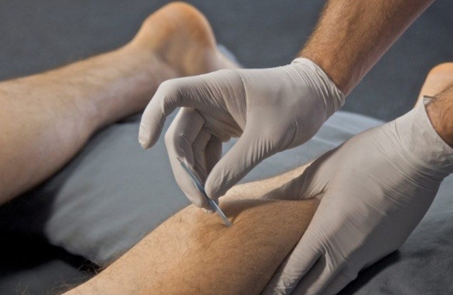 Dry Needling in Sports Injuries: Empowering Athletes to Recover