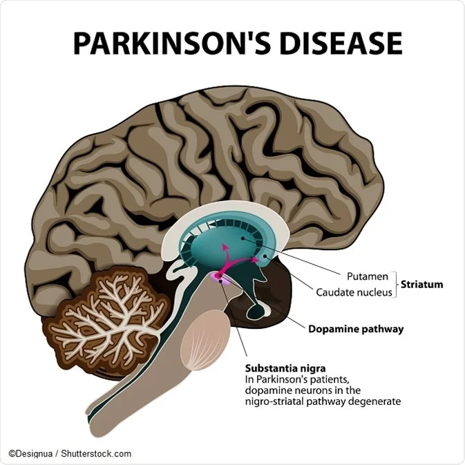 Embracing Hope: Understanding Parkinson’s Disease