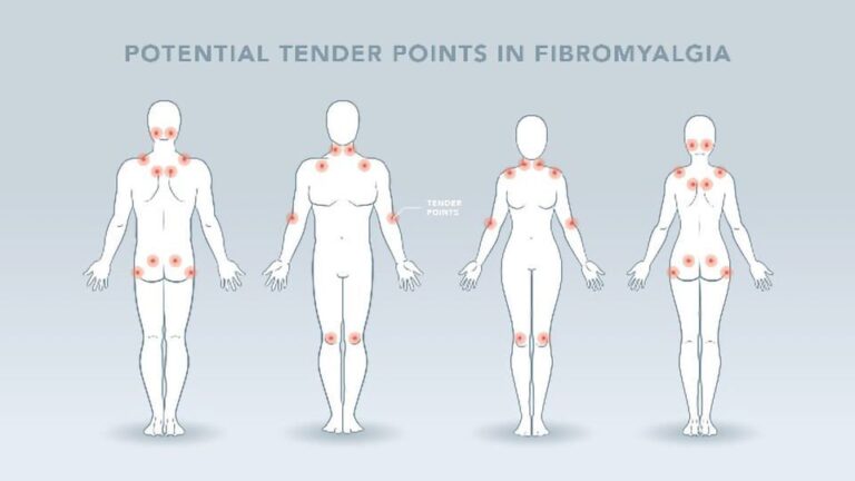 Embracing Wellness: Understanding Fibromyalgia