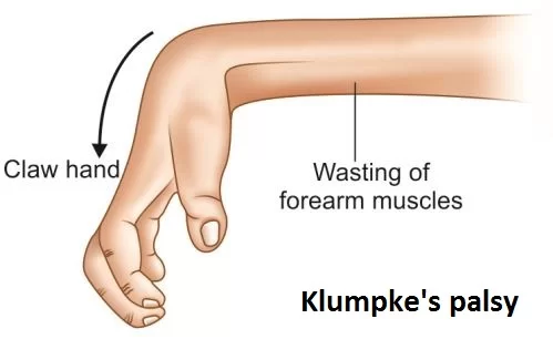 Understanding and Caring for Klumpke’s Paralysis with Compassion
