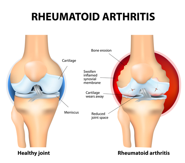 Compassionate Insights into Juvenile Rheumatoid Arthritis (JRA)