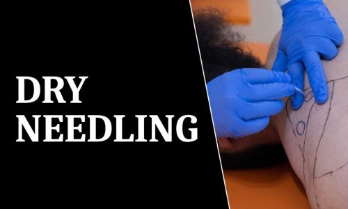 dry needling